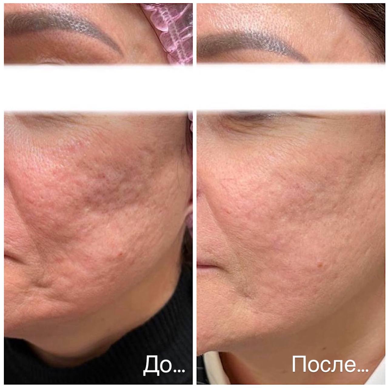 комплексное лечение постакне